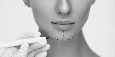 cosmetic surgery lines drawn on womans chin